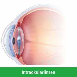 Auge mit implantierter Intraokularlinse