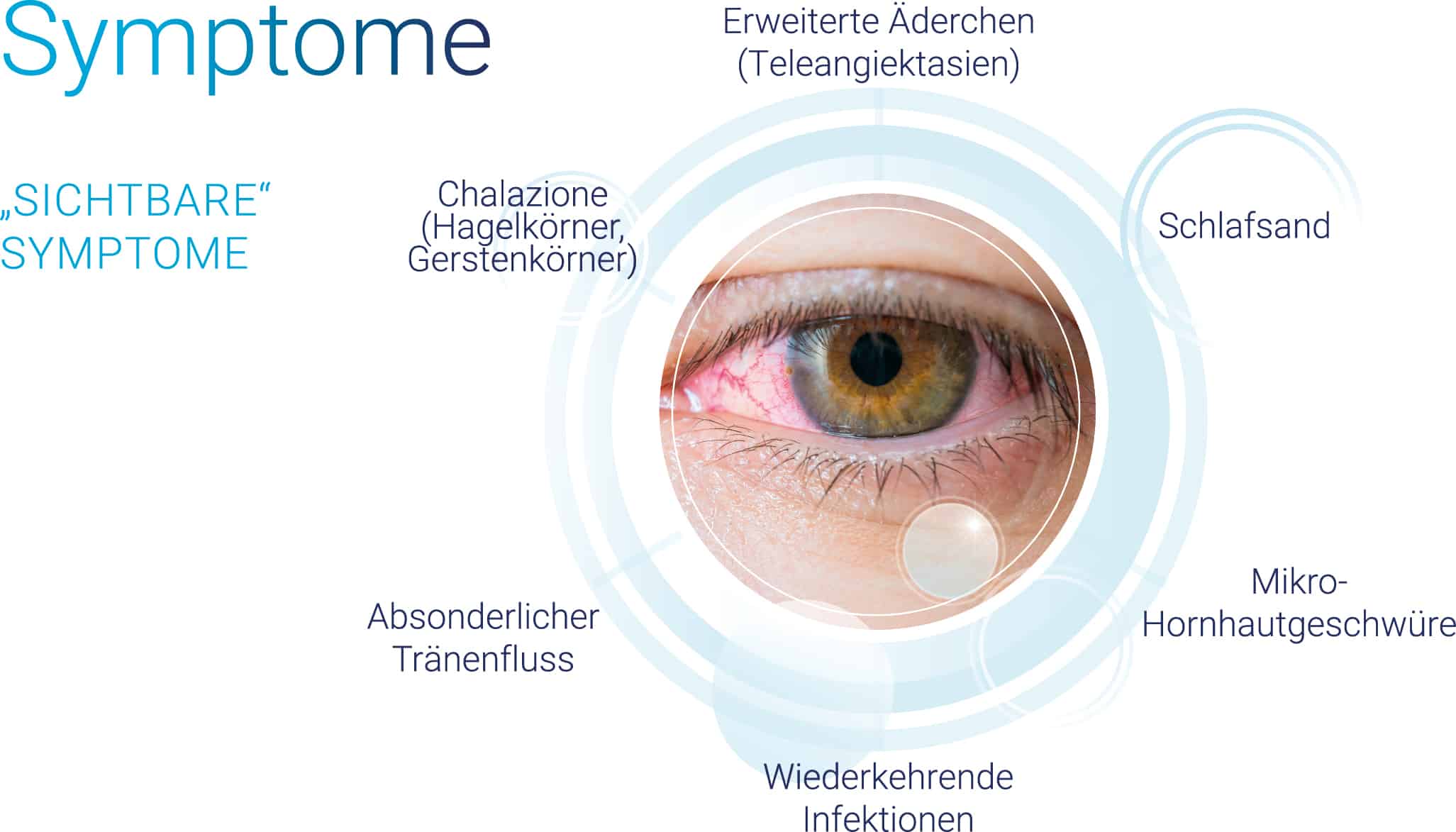 trockene Augen - Symptome: erweiterte Äderchen | Schlafsand | Hornhautgeschwüre | Infektionen | Tränenfluss | Gerstenkörner